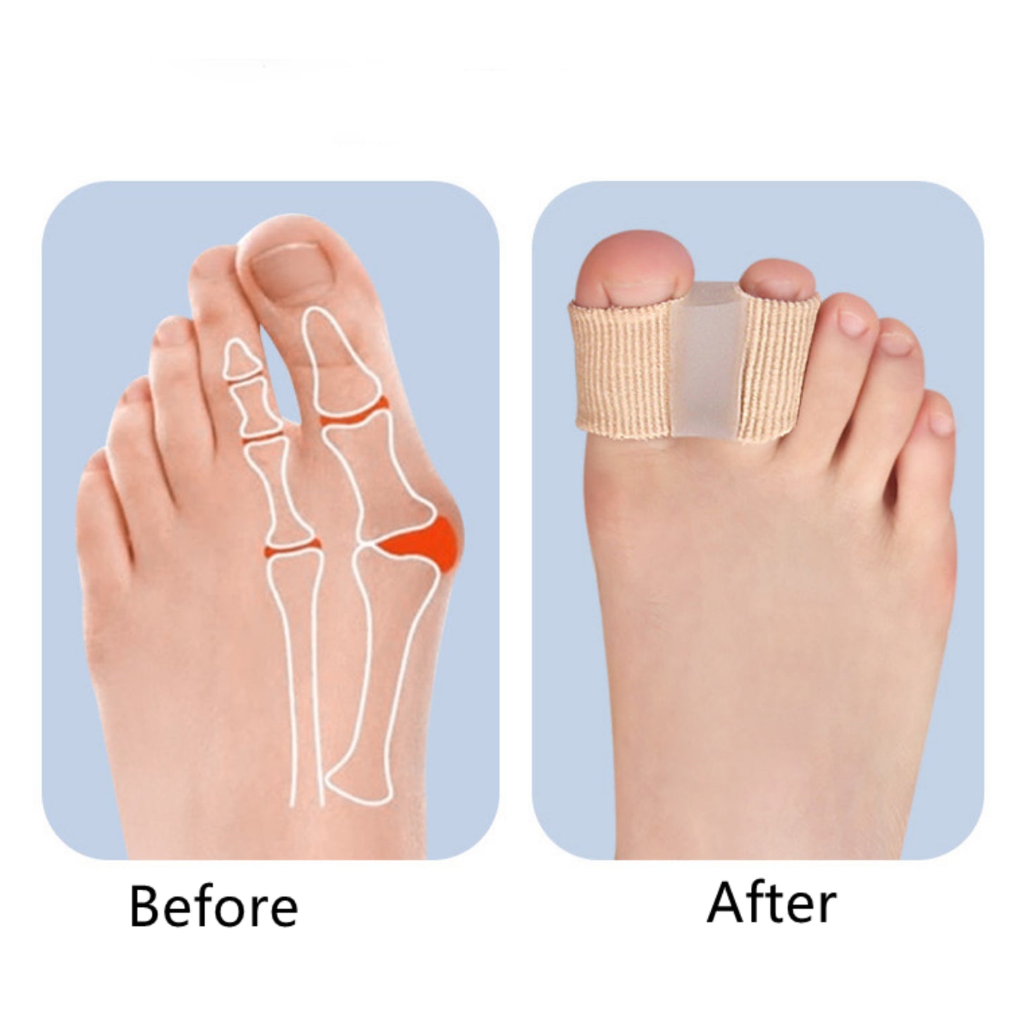 Före- och efterbild som visar hallux valgus med och utan dubbel tåseparator.