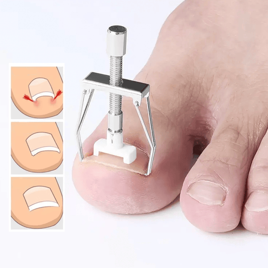 Verktyg för att korrigera nageltrång placerat på stortån.